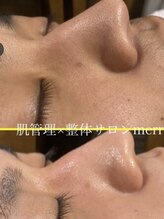 メリー(merry)/アクアピール／毛穴洗浄