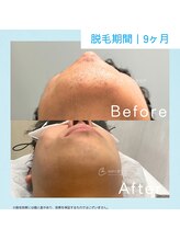 メンズクリア 武蔵小杉店/【メンズクリア】お客様の施術例