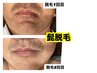 【ご新規様・都度の方用】選べるセレクト脱毛（VIOは2箇所）【¥8800】