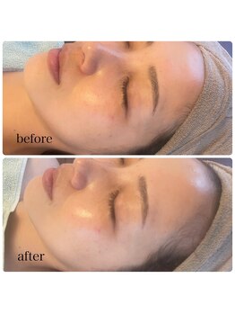 ミレーヴ(MiReve)/シミ・小顔