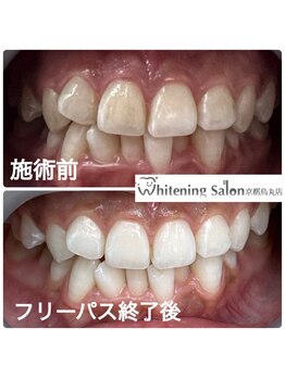 ホワイトニングサロン 京都烏丸店/ホワイトニング施術例