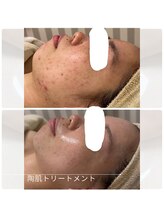 アチェリー(aCherry)/陶肌トリートメント