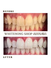 ホワイトニングショップ 高田馬場店/ホワイトニングBefore After