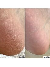 ベッレ マーニ/足裏角質ケア