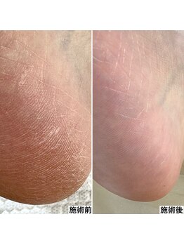 ベッレ マーニ/足裏角質ケア