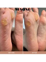 マオヌー(MAONU)/韓国式足裏角質ケア　症例写真