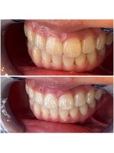 エクシアホワイトニング 代々木店/ホワイトニングは大切