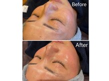 マツヤニ＋クレイでお肌の余分なものを除去し潤いを与えましょう