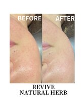 プレイス 堂山本店(PLACE)/剥離しないハーブピーリング