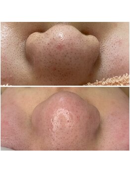 グランデ(Grande)/毛穴洗浄