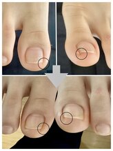 ドクターネイル爪革命 麻布十番店/【足の爪切り】フットケア