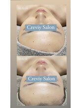 クレヴィー(Creviy)/陶肌トリートメント×光フォト