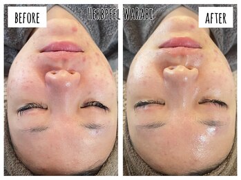 ハオン(HAON)/ハーブピーリング/ニキビ/毛穴