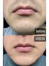 ヴィーナス(Venus)/髭脱毛 before→10回目