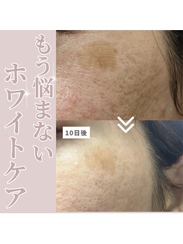 トータルビューティーサロン ヴィヴィエ(ViVier)/ホワイトケア