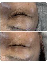 エミニー(Eminy)/EMS±プラズマ