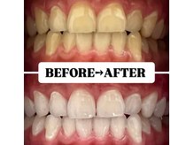 ホワイトニングサロン 豊中/Before&After美白ホワイトニング