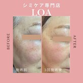 ロア(loa)