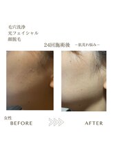 サロンエイトミー 西船橋店(salon 83)/毛穴ケア/顔脱毛before→after