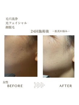 サロンエイトミー 西船橋店(salon 83)/毛穴ケア/顔脱毛before→after