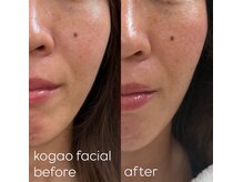 マイルーム(my room)/月一肌管理　小顔フェイシャル