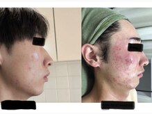 キヨラビューティーの雰囲気（ニキビケア/ピーリング/光フェイシャル）