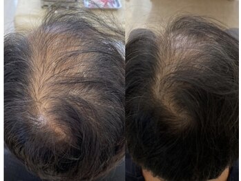 カナエル ビューティーサロン(Canael Beauty salon)/プロセルセラピーズ 2回