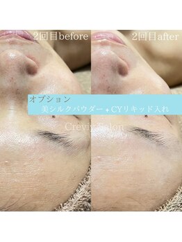 クレヴィー(Creviy)/陶肌トリートメント2回目