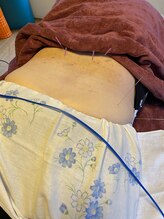 ライズ/腰部　臀部への鍼の施術