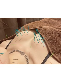 鍼灸施術を受けたい