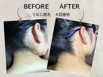 ワンアップ(One-up)/うなじ脱毛 ４回　before  after
