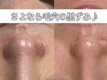 サロンノワ(salon noix)/《毛穴も綺麗になります☆》