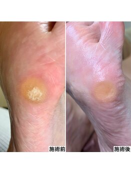 ベッレ マーニ/足裏角質ケア