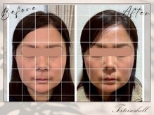 トーティシェル(tortoise shell)/理想の卵型輪郭に