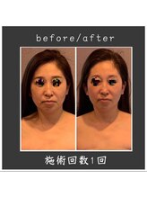 サロン ド ハーモニー美/コルギ♪小顔・小鼻を小さく等