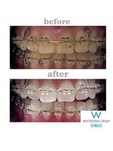 ホワイトニングショップ 宮崎店/【矯正中でも大丈夫】