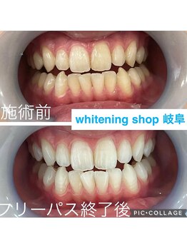ホワイトニングショップ 岐阜駅前/#岐阜ホワイトニング#岐阜エステ