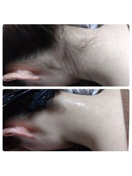 ルアナ(Luana)/うなじデザイン脱毛で垢抜け♪