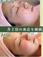 サロンド ヴィーナス 葛西店/ハーブピーリングでニキビ対策