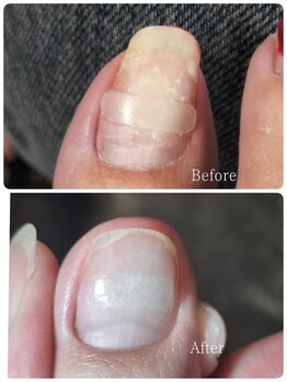 【巻き爪】11,000円→5,500円