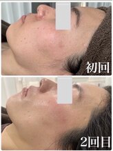 リュミエール デスポワール(Lumiere d'espoir)/ハーブピーリング