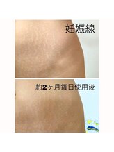 パリライム(parislime)/痩せても消えない妊娠線