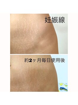 パリライム(parislime)/痩せても消えない妊娠線