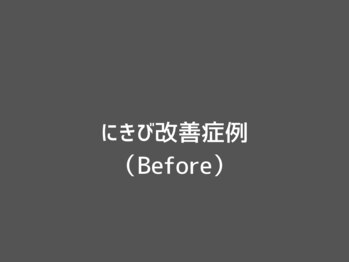 オアシスラグーン(OASIS LAGOON)/ニキビ改善