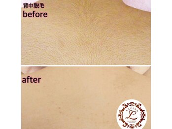 ラウレア 松山店(LAULEA)/背中美肌脱毛