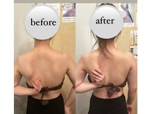 カシェット(cachette)/肩甲骨剥がし