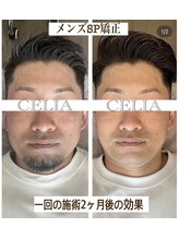 セリア(CELIA)/小顔矯正/メンズ/小顔