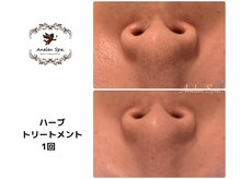 アネランスパ(Anelan Spa.)/毛穴の開きや黒ずみ毛穴のケア