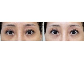 エレガンテ(ELEGANTE)/最新プラズマシャワー　