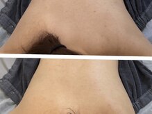 シード(SHE°)/ハーブピーリング(お背中)